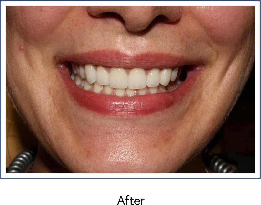 Dental veneers therapy after picture