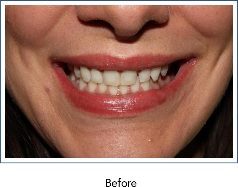 Dental veneers therapy before picture