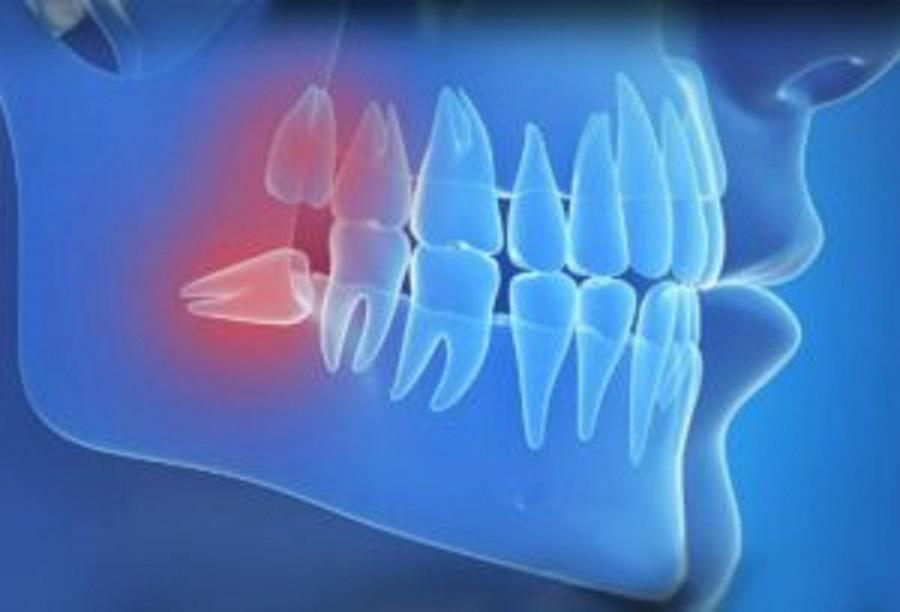 Impacted wisdom tooth illustration