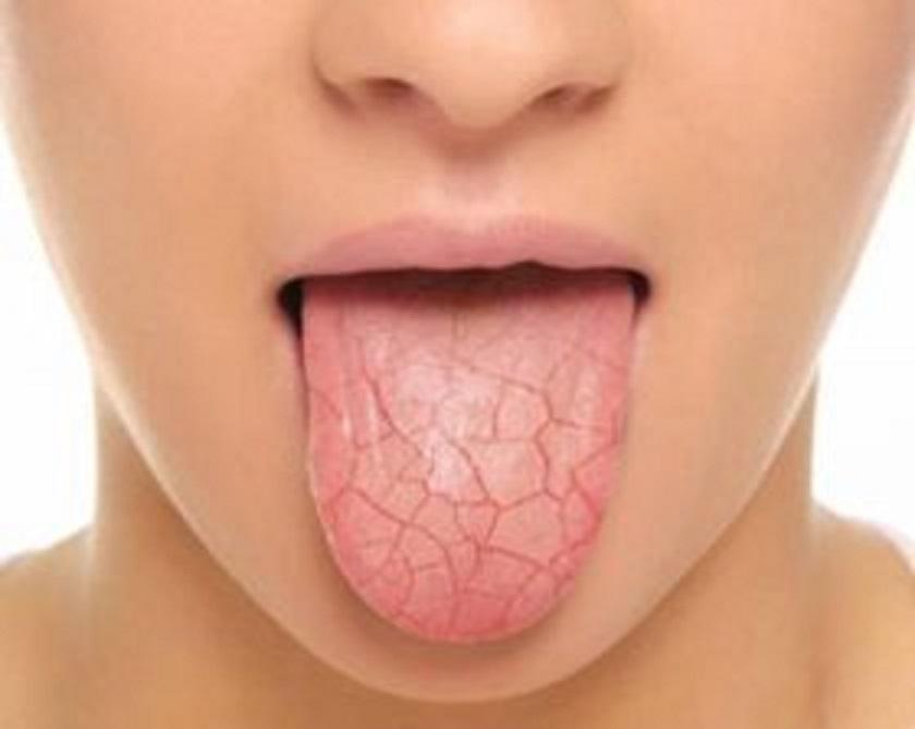 Woman with tongue sticking out textured to show dryness