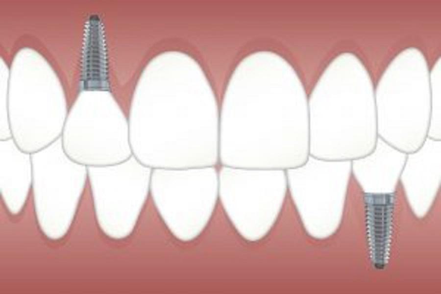 Illustration of dental implants and crowns