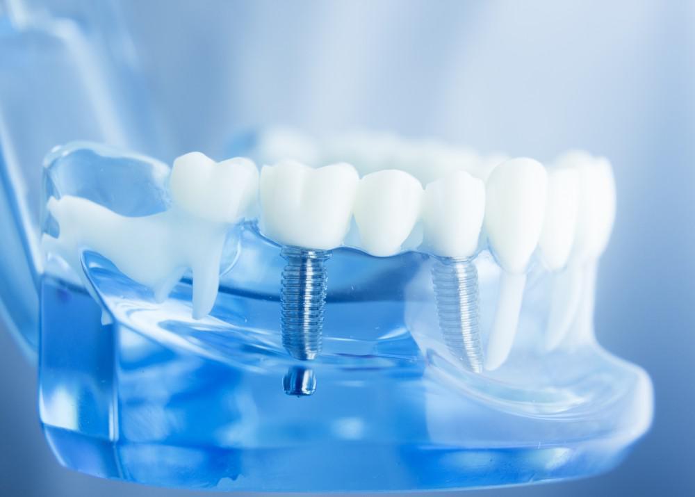 Model of dental implant and crown in a jaw