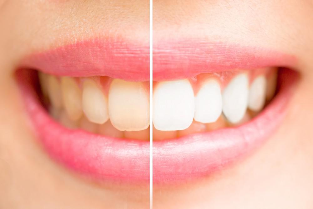 Side by side comparison of yellow teeth vs white teeth