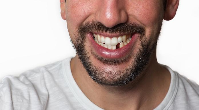 Smiling man with missing tooth
