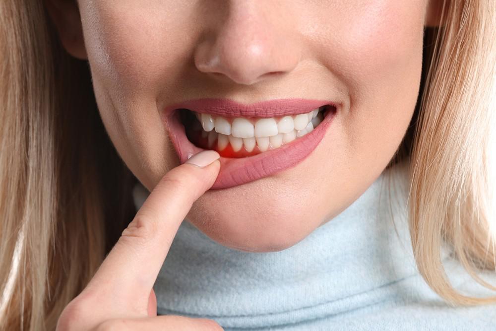 Woman exposing gum to show red inflamed gums
