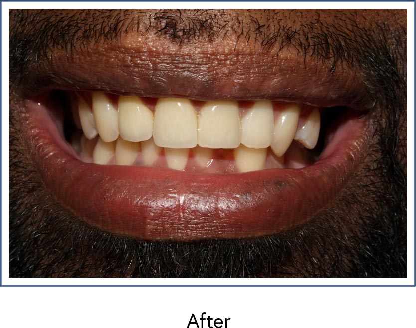 Cosmetic crowns on anterior teeth after picture