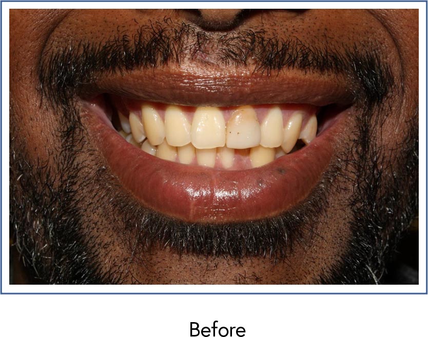 Cosmetic crowns on anterior teeth before picture