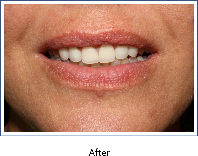 Dental veneers after picture