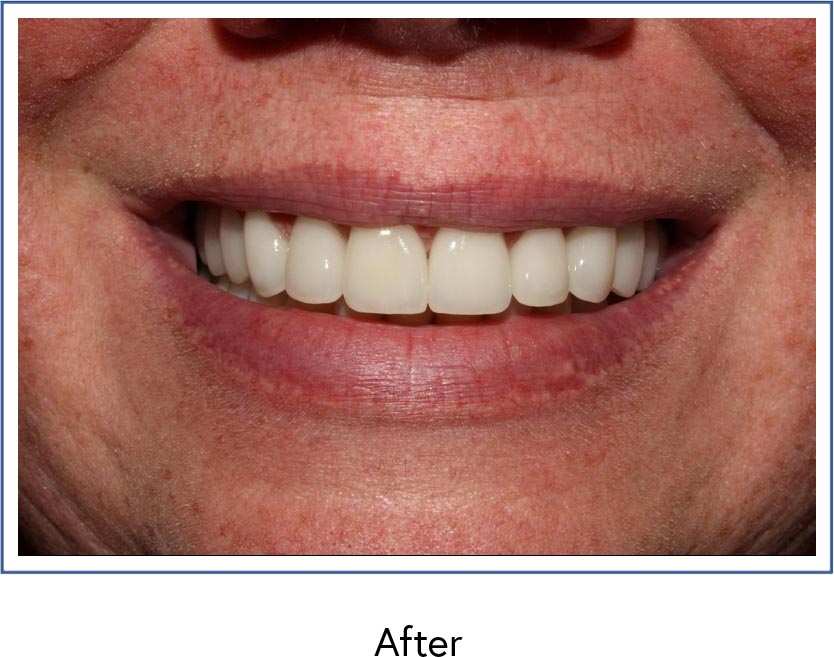 Crowns and periodontal therapy after picture