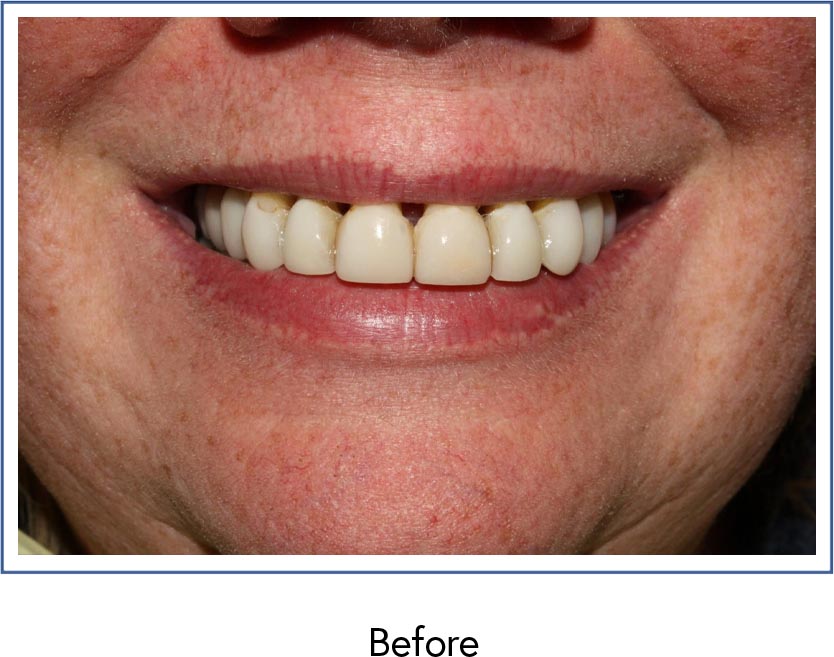 Crowns and periodontal therapy before picture