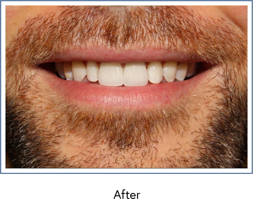 Dental crowns after picture