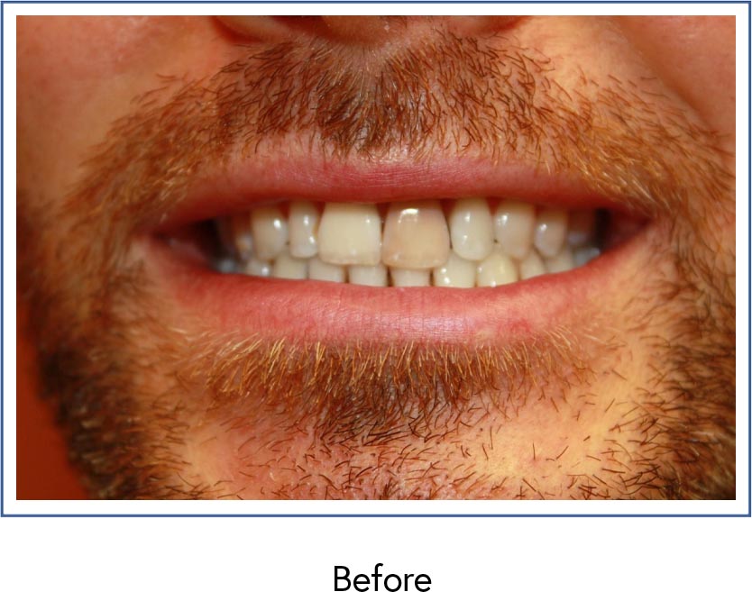 Dental crowns before picture