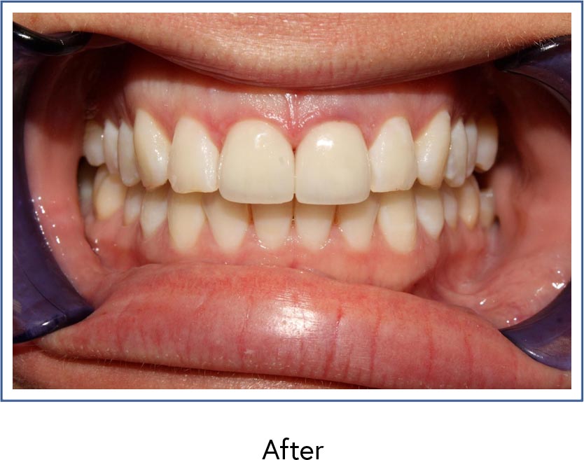 Dental veneers therapy after picture