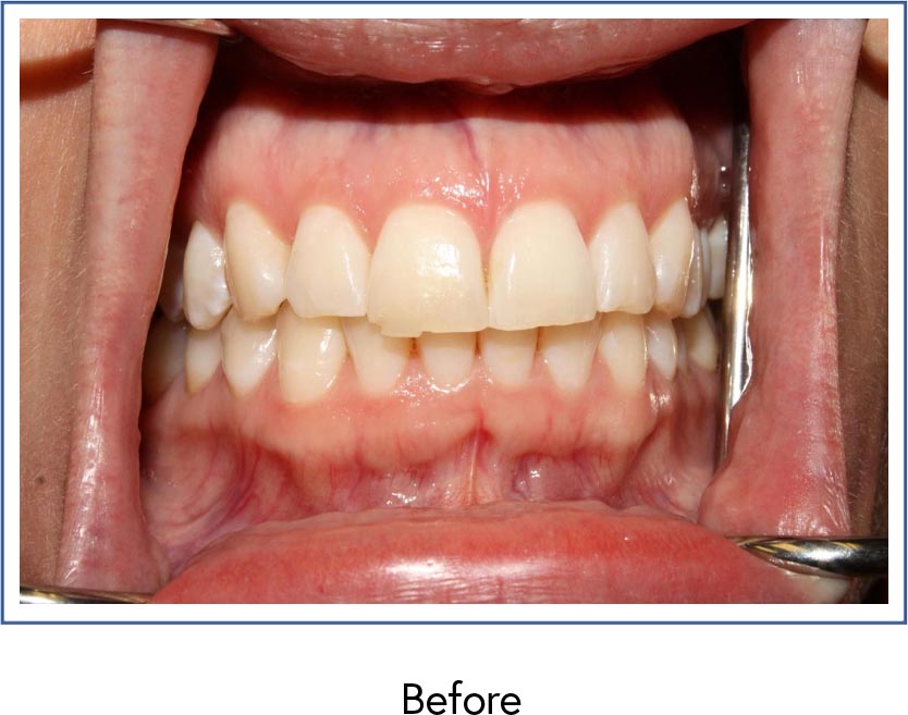 Dental veneers therapy before picture