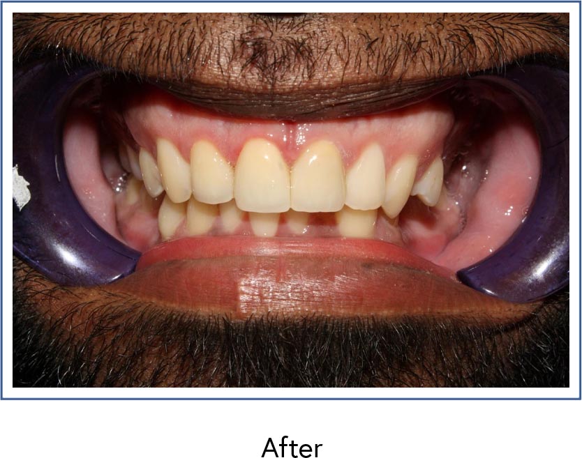 Dental crowns after picture