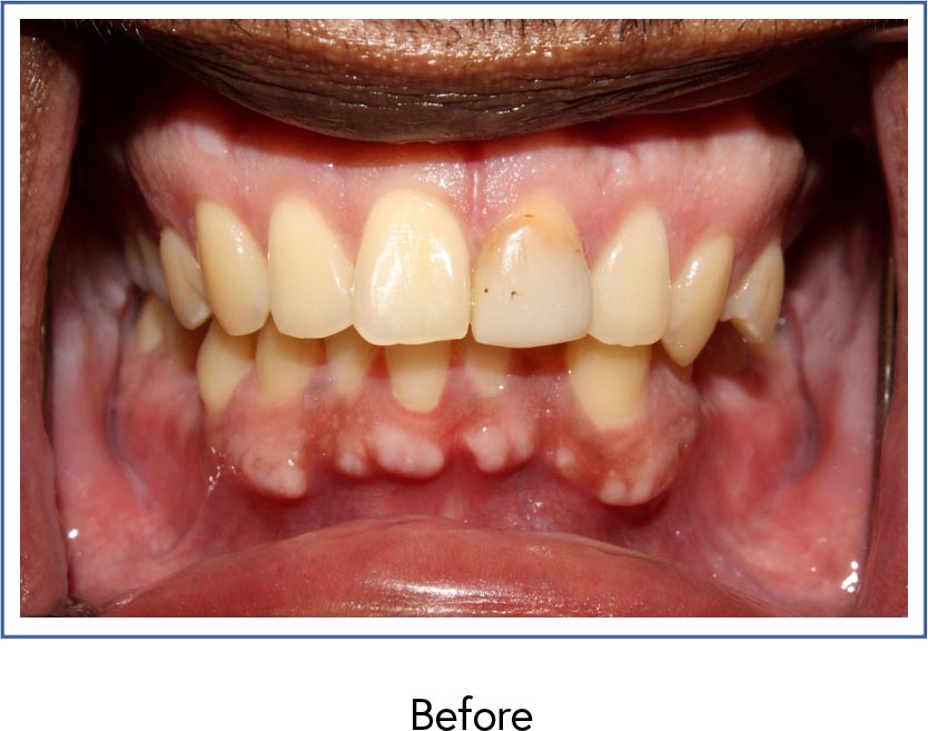 Dental crowns before picture