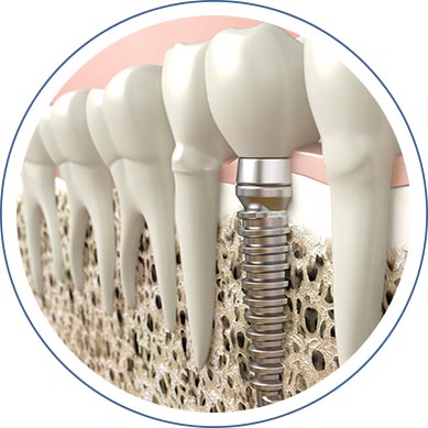 Replacing Multiple Teeth With Implant in Washington, DC