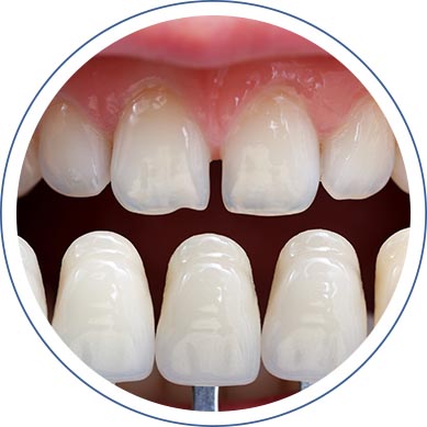 Cosmetic Dentistry: Porcelain Dental Veneers in Washington, DC