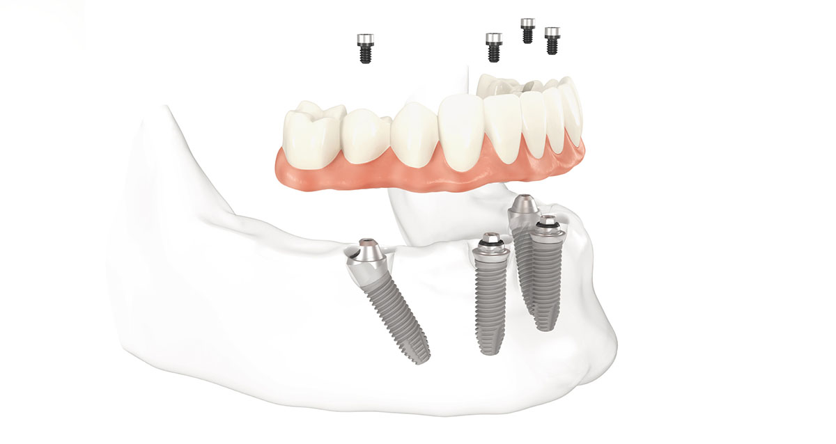 3D diagram showing a denture screwing into four dental implants on a lower jaw
